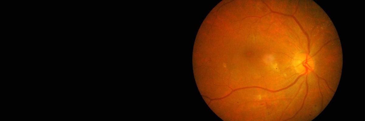 urgences ophtalmologiques paris chirurgiens ophtalmologues specialistes paupieres chirurgie refractive cataracte retine glaucome paris centre ophtalmologique ophtalmologie paris est urgences ophtalmologiques paris chirurgiens ophtalmologues specialistes paupieres chirurgie refractive cataracte retine glaucome paris centre ophtalmologique ophtalmologie paris est