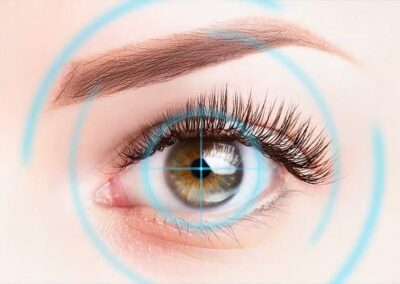 Quelle technique de chirurgie réfractive pour la myopie?