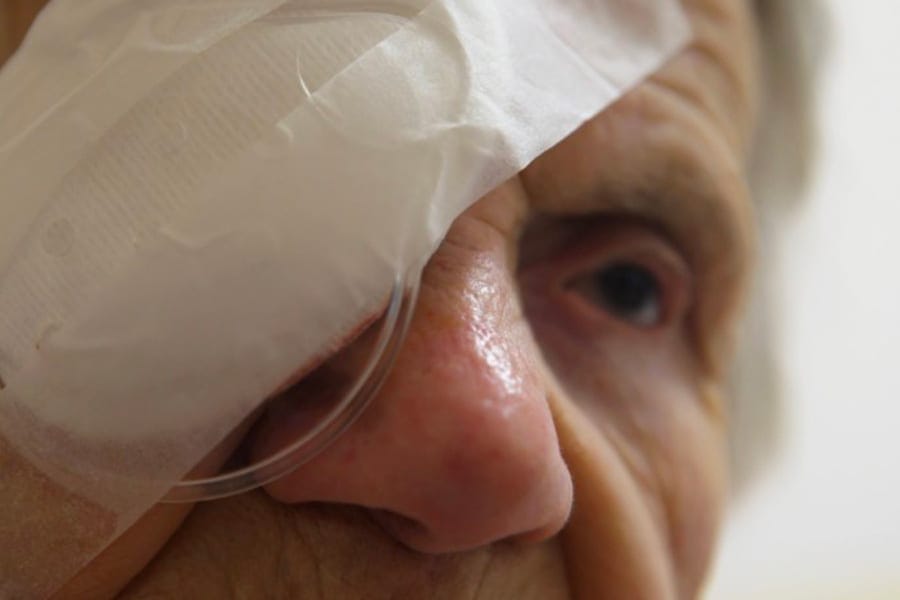 combien de temps garder la coque apres operation cataracte chirurgien ophtalmologue specialiste cataracte centre ophtalmologiste ophtalmologie paris est