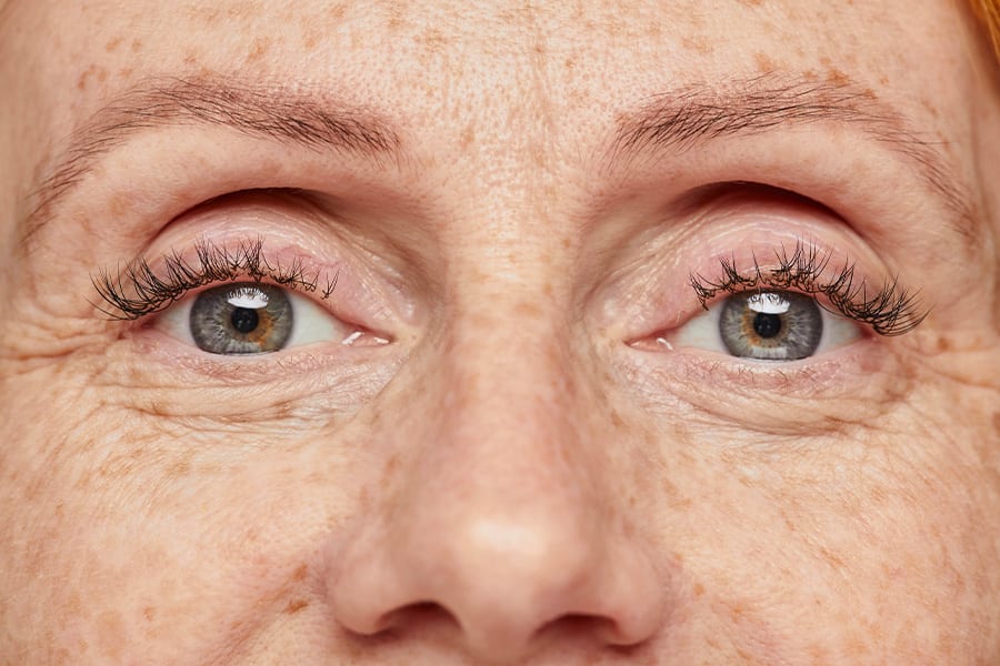 ride patte d oie age botox medecine ophtalmologie esthetique chirurgiens ophtalmologues paris centre ophtalmologique ophtalmologie paris est