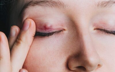 Chalazion à l’œil : quel est son traitement ?