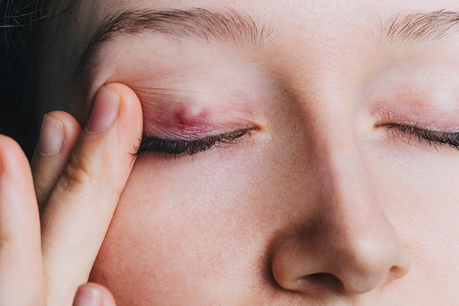 chalazion oeil traitement chirurgiens ophtalmologues specialistes paupieres paris centre ophtalmologique paris est chalazion oeil traitement chirurgiens ophtalmologues specialistes paupieres paris centre ophtalmologique paris est